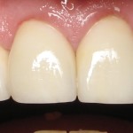 Porcelain veneers are more durable and less likely to stain than veneers
