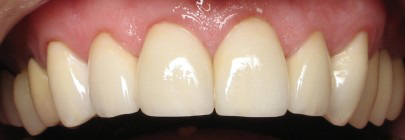 Porcelain veneers are more durable and less likely to stain than veneers