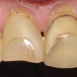 Dental veneers (sometimes called porcelain veneers or dental porcelain laminates