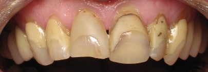 Dental veneers (sometimes called porcelain veneers or dental porcelain laminates