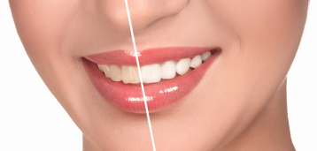 porcelain-veneers